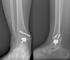 mini-protesi-su-misura