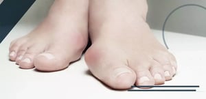 RADIOGRAPHIC-CONSIDERATIONS-HALLUX-VALGUS-VERSUS-HALLUX-RIGIDUS-min